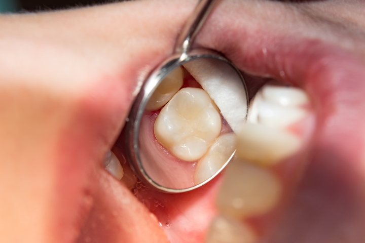 filling1 Gum Disease Diagnosis