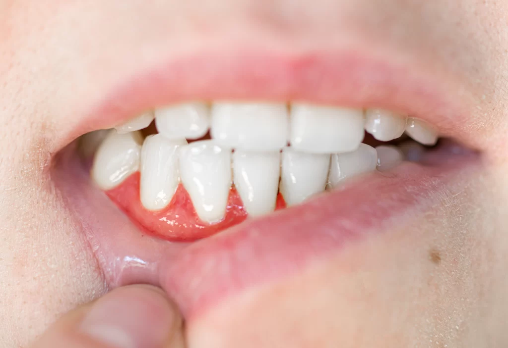 PERIODONTAL Disease MAINTENANCE